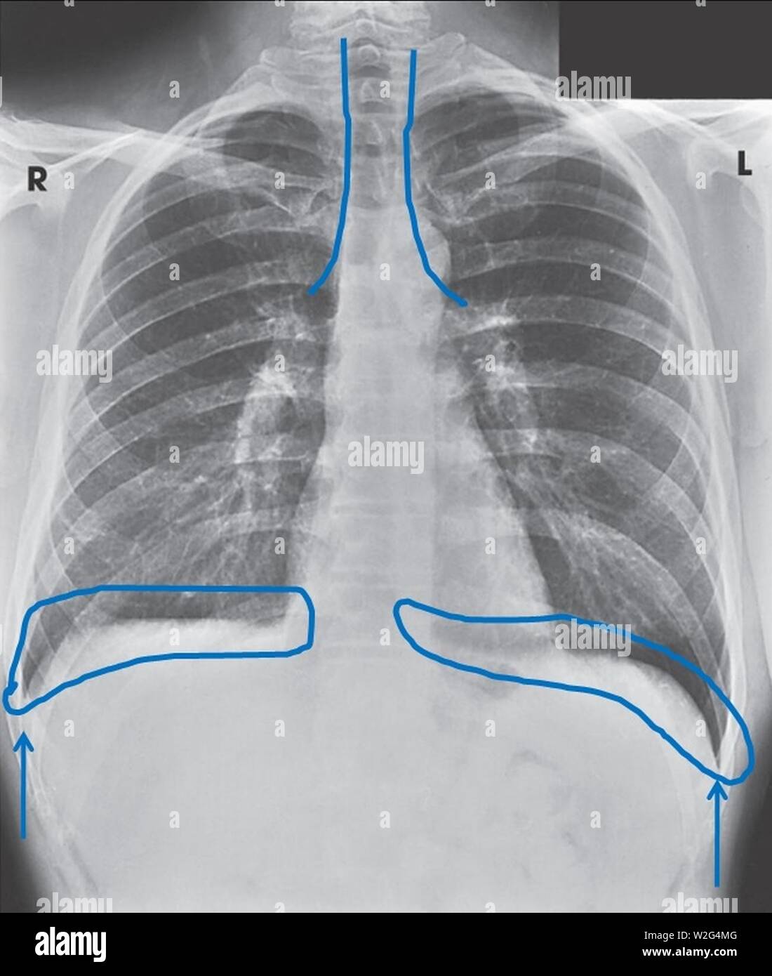 Vintage chest x ray hi-res stock photography and images - Alamy