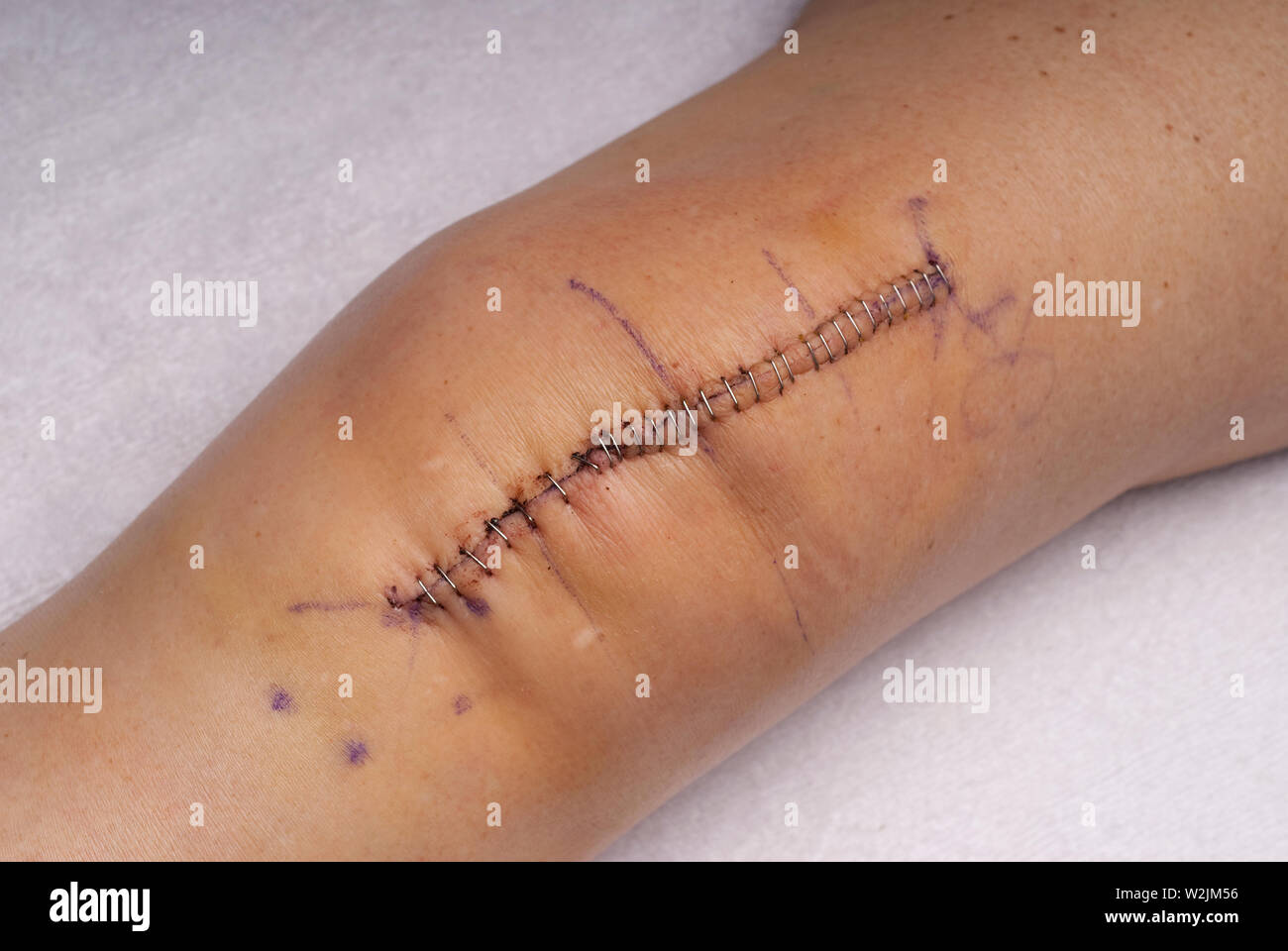 Metal staples used to stitch up skin after a replacement knee surgery operation Stock Photo