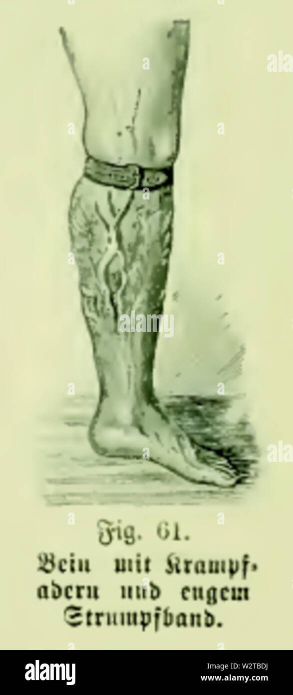 Die Frau als Hausärztin (1911) 061 Bein mit Krampfadern und engem Strumpfband Stock Photo