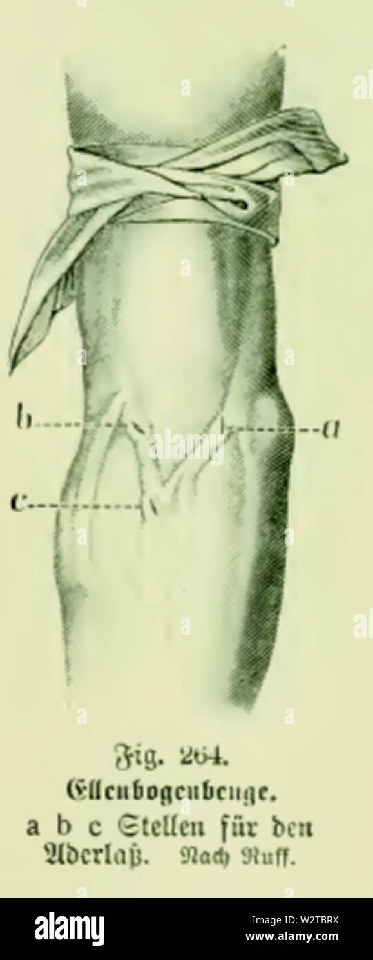 Die Frau als Hausärztin (1911) 264 Stellen für den Aderlaß an der Ellenbogenbeuge Stock Photo