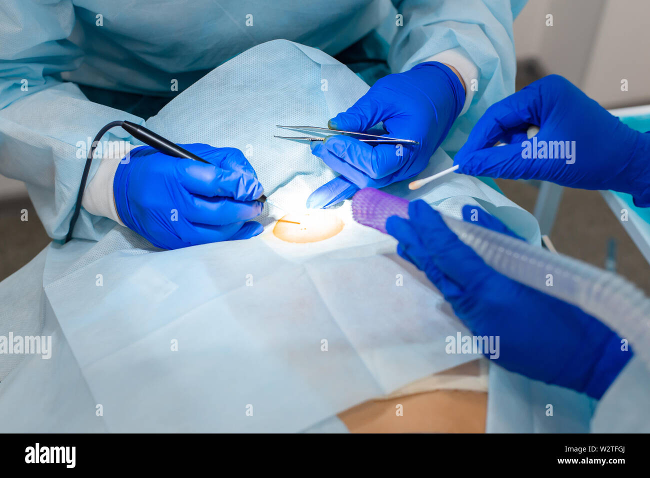 The surgeon does surgery to remove the mole on the patient's back. The