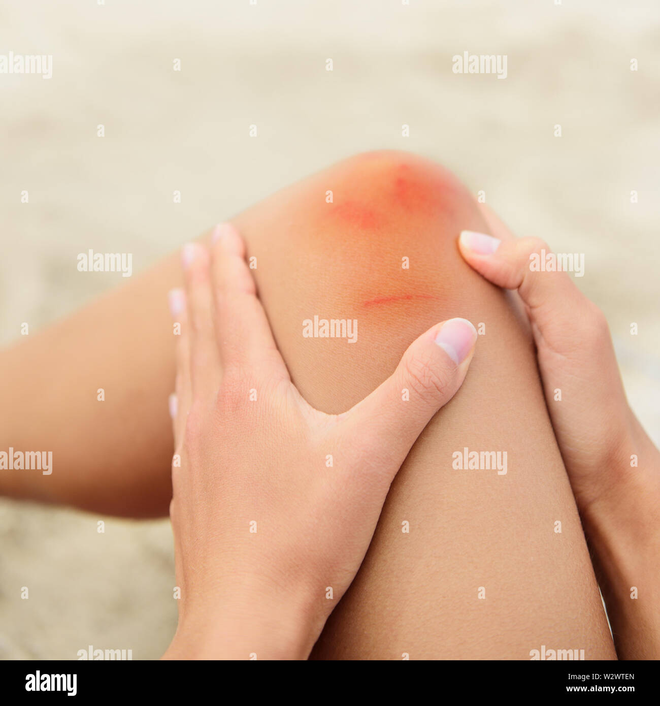 Woman nursing an injured bruised grazed knee with surface petechia on the skin and tissue discoloration in her hands in a healthcare and medical concept, close up of the joint and hands Stock Photo