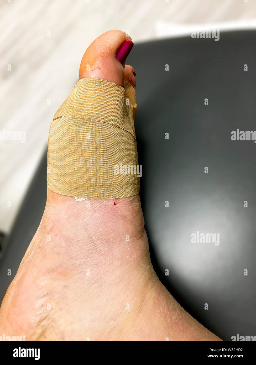 Day 10 after bunion and hammertoe surgery. Stitches were removed and the foot was bandaged at the podiatrist’s office. Stock Photo