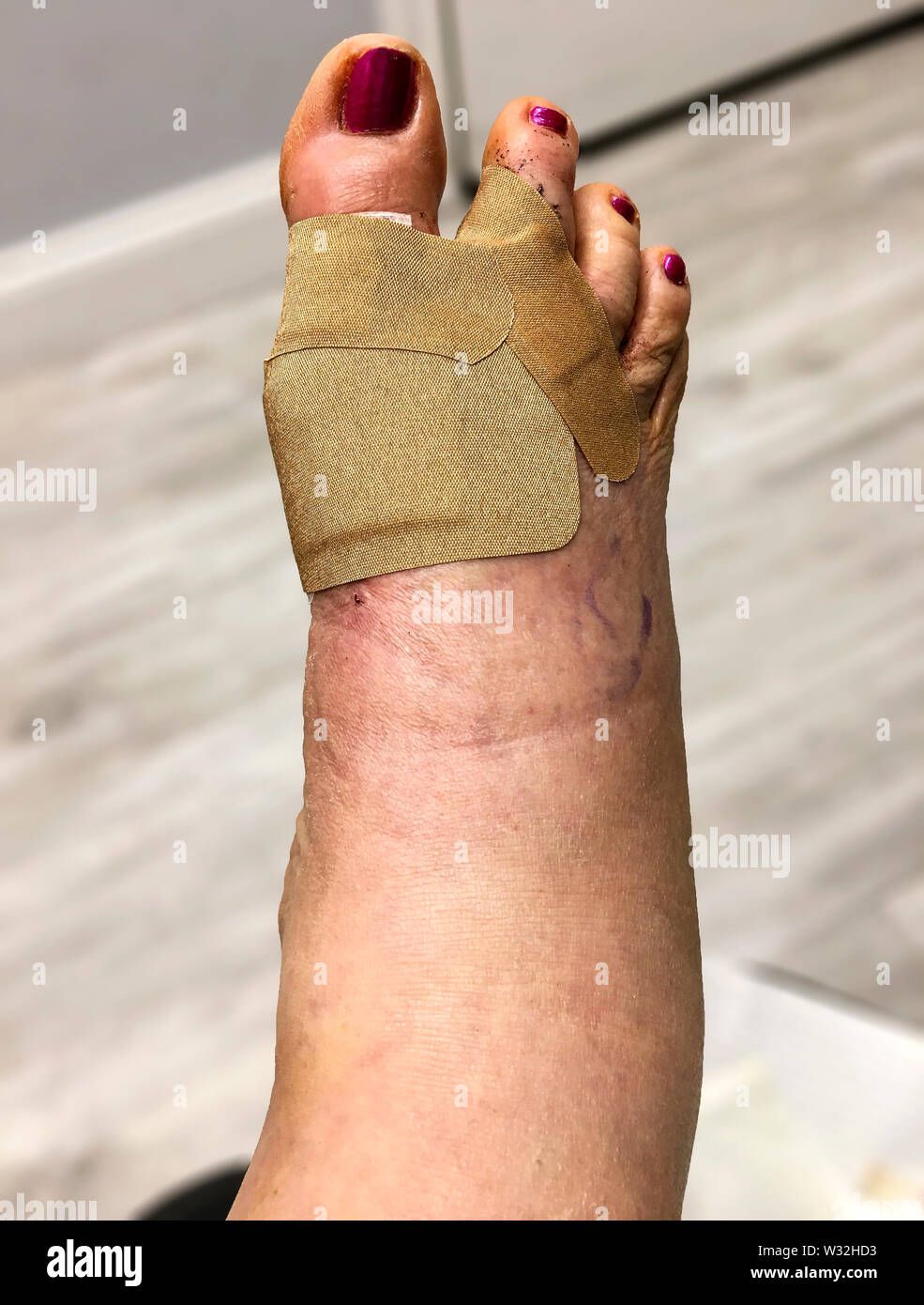 Swollen foot hires stock photography and images Alamy