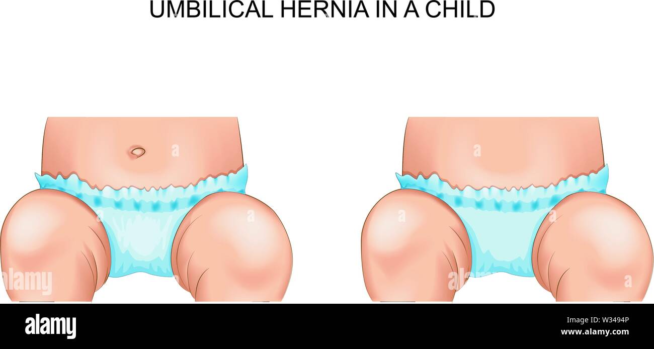 vector illustration of an umbilical hernia in a child Stock Vector