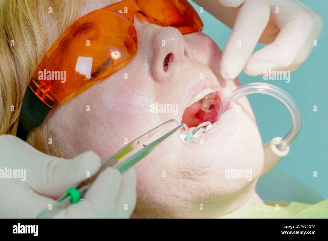 Closeup of dental treatment. A dental suction system collects blood