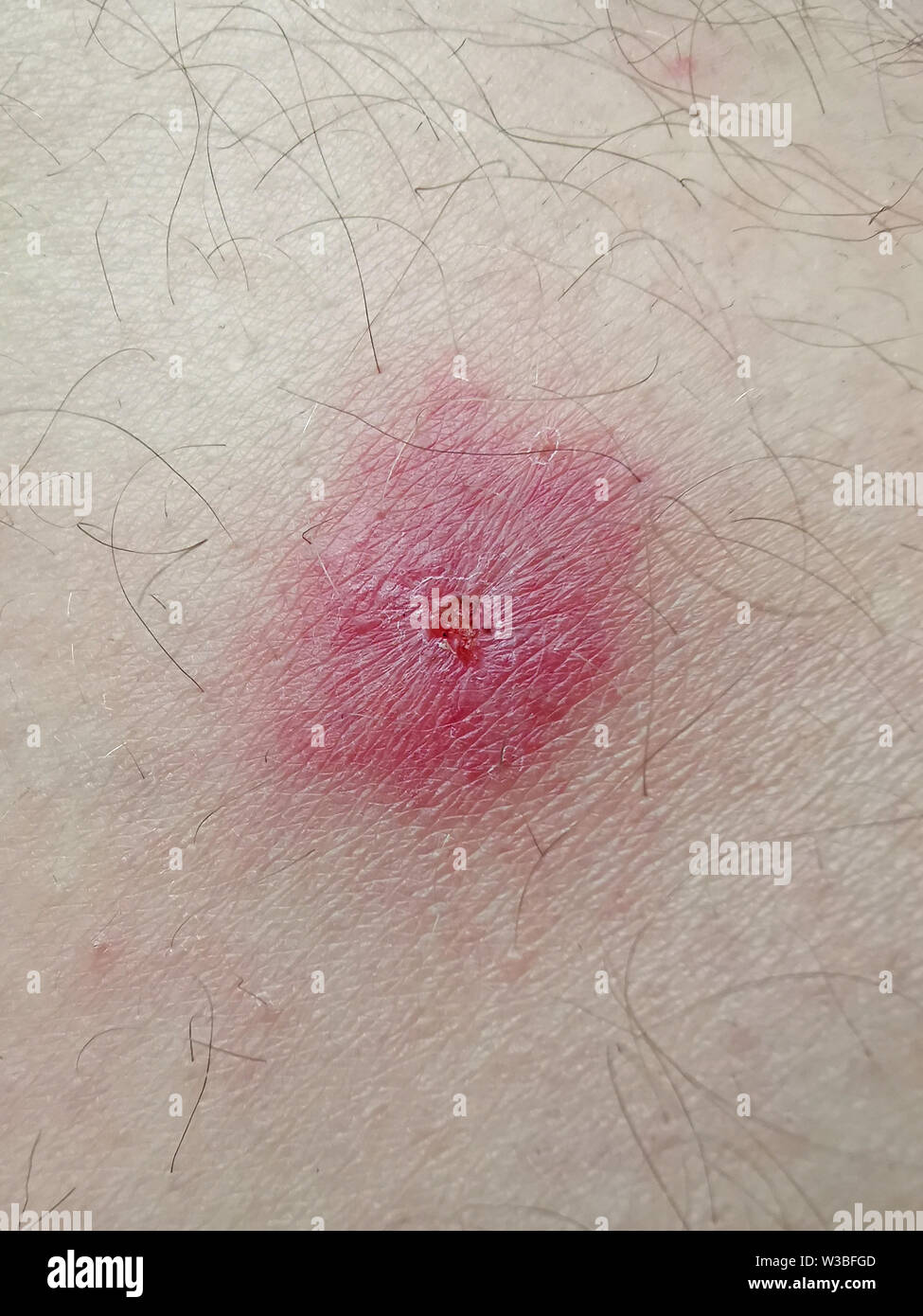 Closeup image of a bug bite on human skin Stock Photo Alamy