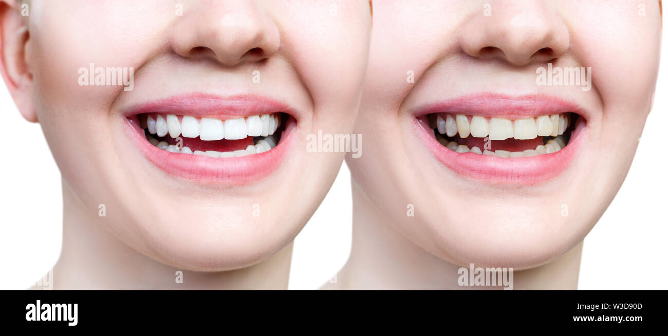 Teeth of young woman before and after whitening and buildup. Isolated