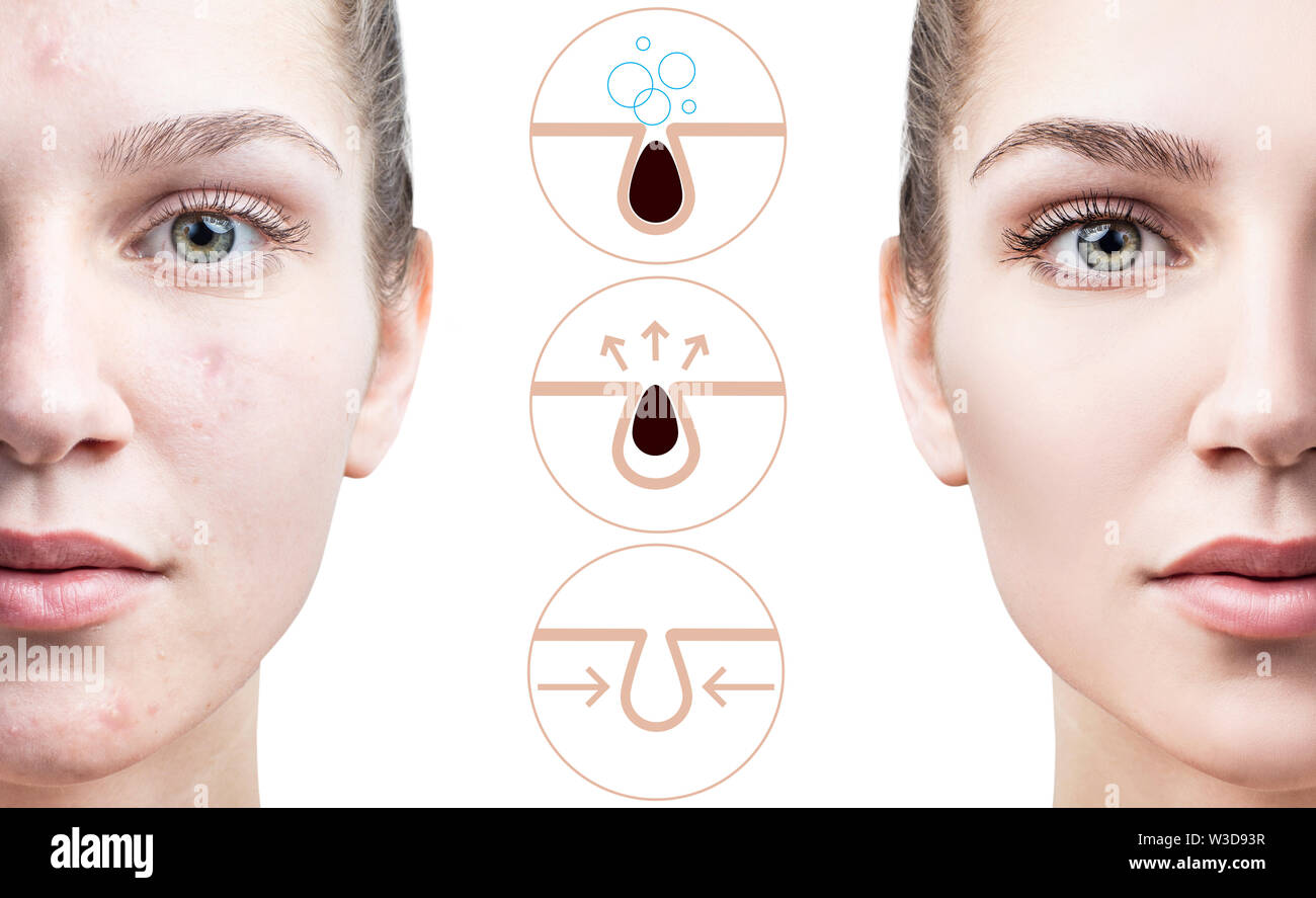 Graphically shows how to pollute and clean the pores on face. Increased skin area with blackhead. Stock Photo