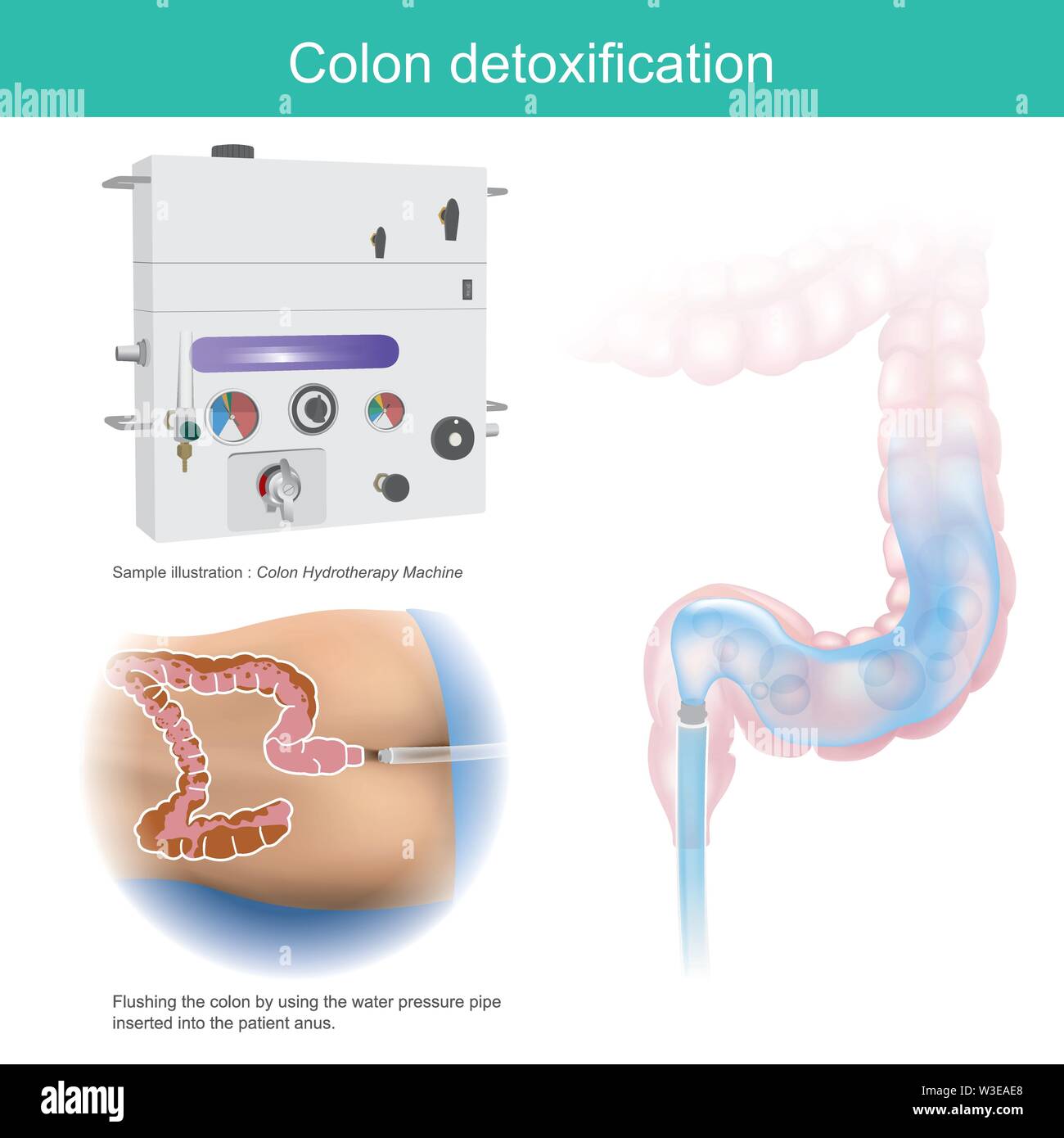 Colon detoxification. Sample illustration flushing the colon by using the water pressure pipe inserted into the patient anus. Stock Vector