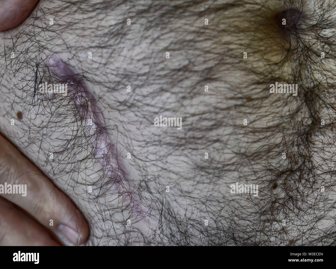 Appendix scar hi-res stock photography and images - Alamy