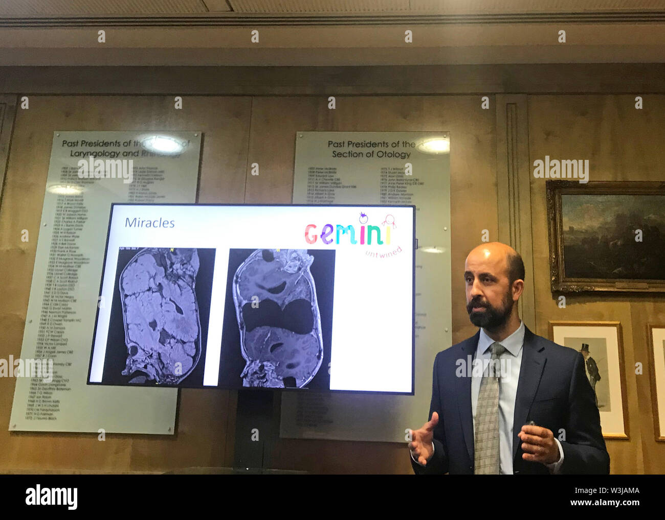 Paediatric neurosurgeon Noor ul Owase Jeelani, speaking during the Gemini Untwined charity launch, as the successful separation of conjoined twins by a UK team will help restore the country's global reputation as divisions over Brexit prevail, he has said. Stock Photo