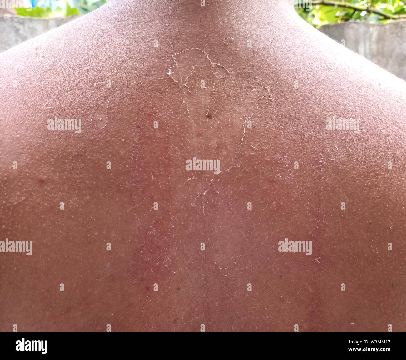 Exfoliation of the skin after sunburn. Excessive tan. The effects of