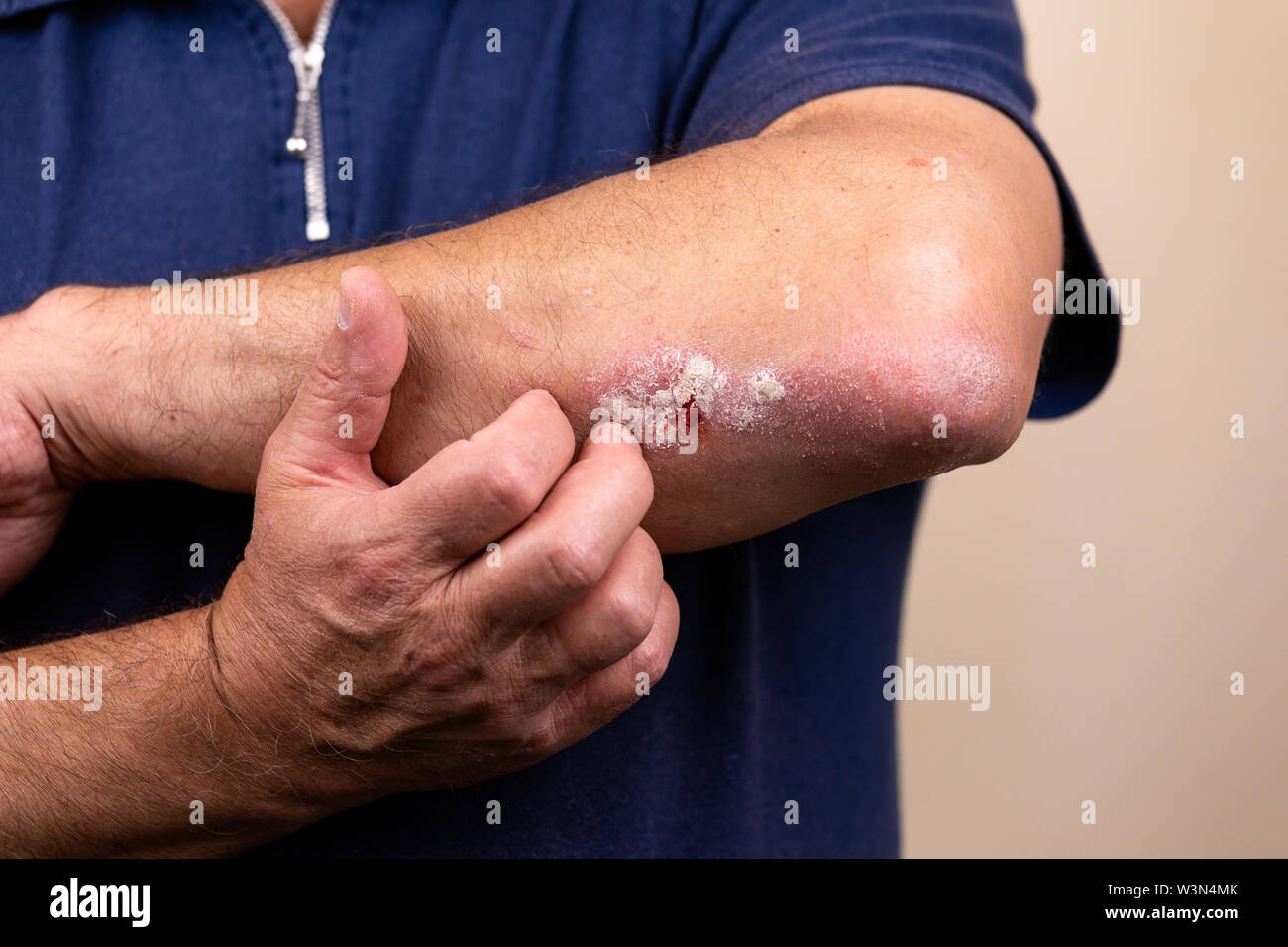 Close up dermatitis on skin, ill allergic rash dermatitis eczema of patient , atopic dermatitis symptom skin detail texture , Fungus The concept derma Stock Photo