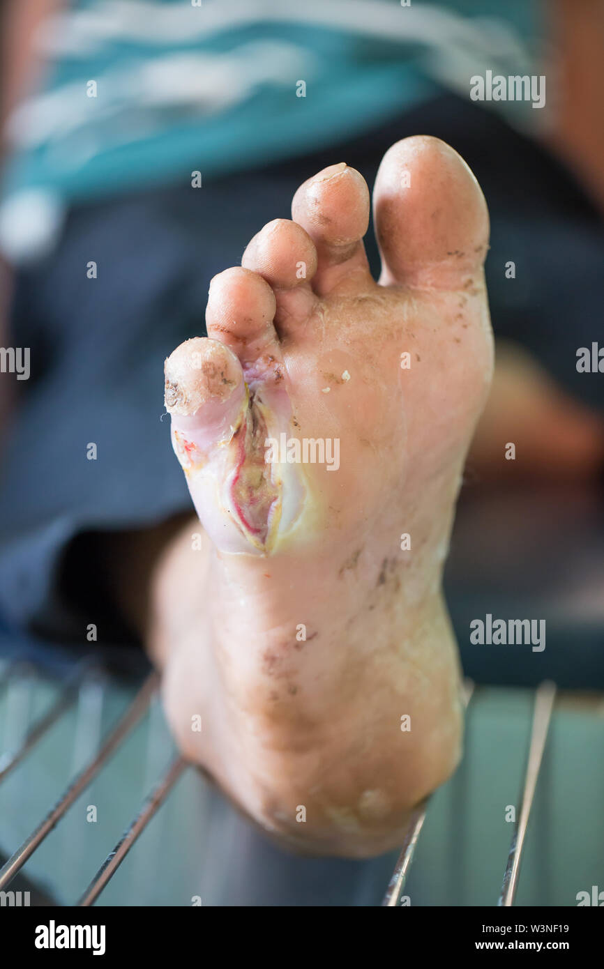 Foot ulcers from diabetes Stock Photo