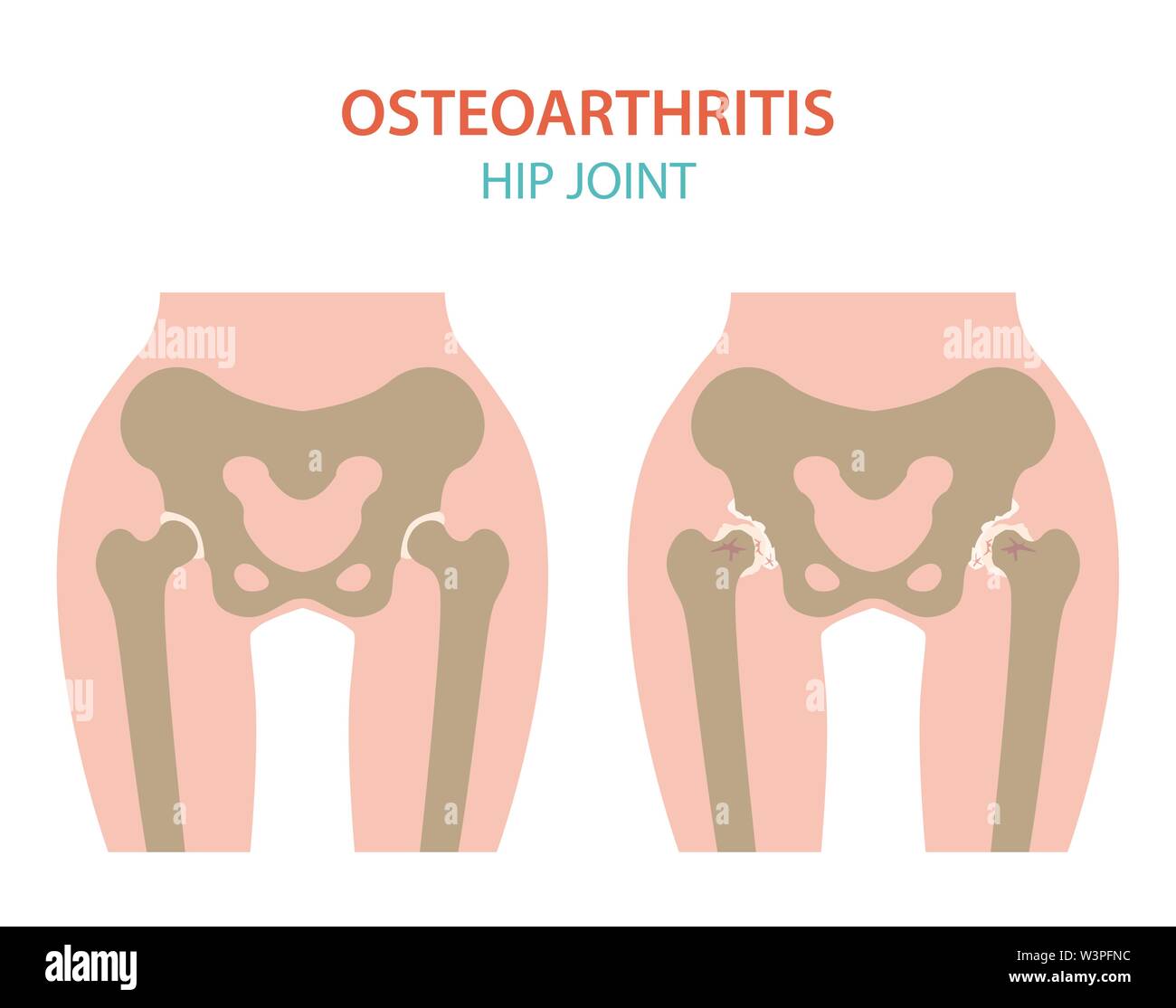 Arthritis, osteoarthritis medical infographic design. Joint replacement