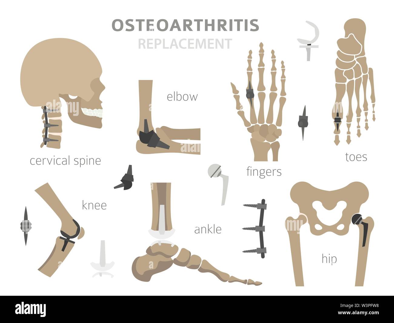 Arthritis, osteoarthritis medical infographic design. Joint replacement, implantant. Vector illustration Stock Vector