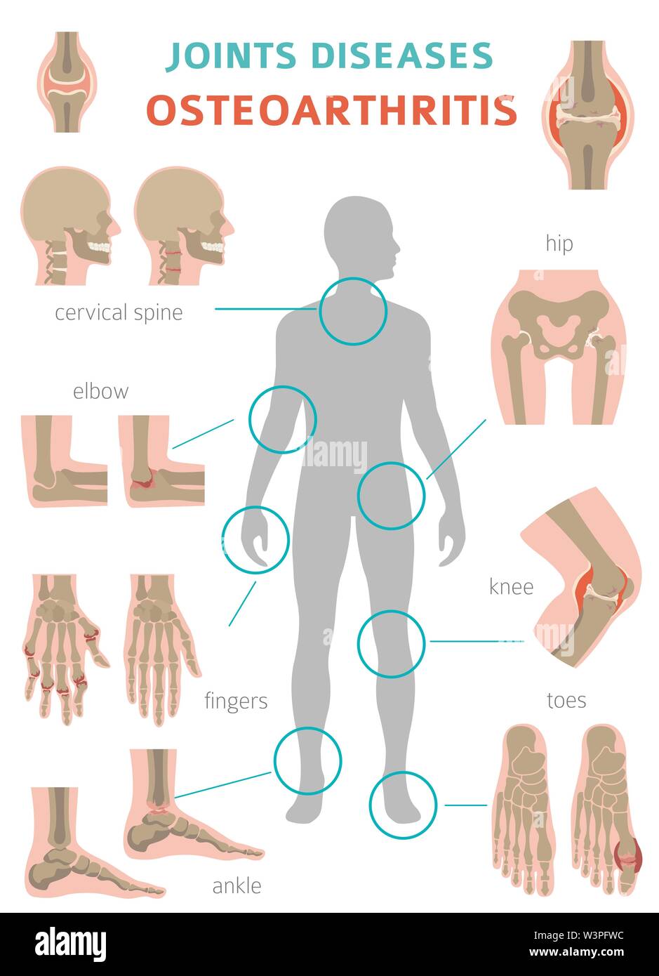 Arthritis, osteoarthritis medical infographic design. Joint replacement