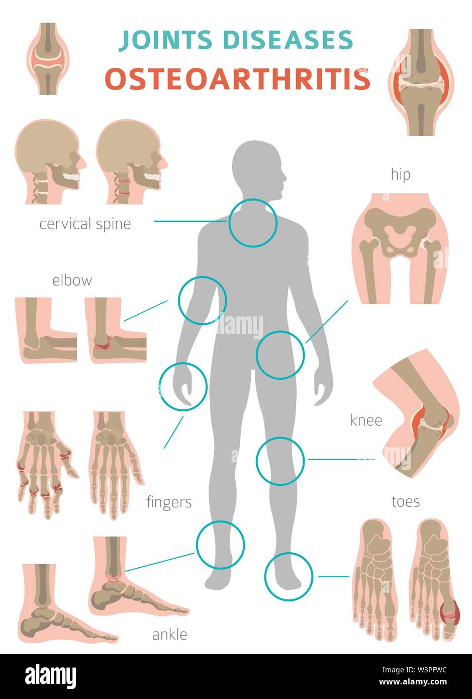 Arthritis, osteoarthritis medical infographic design. Joint replacement, implantant. Vector illustration Stock Vector