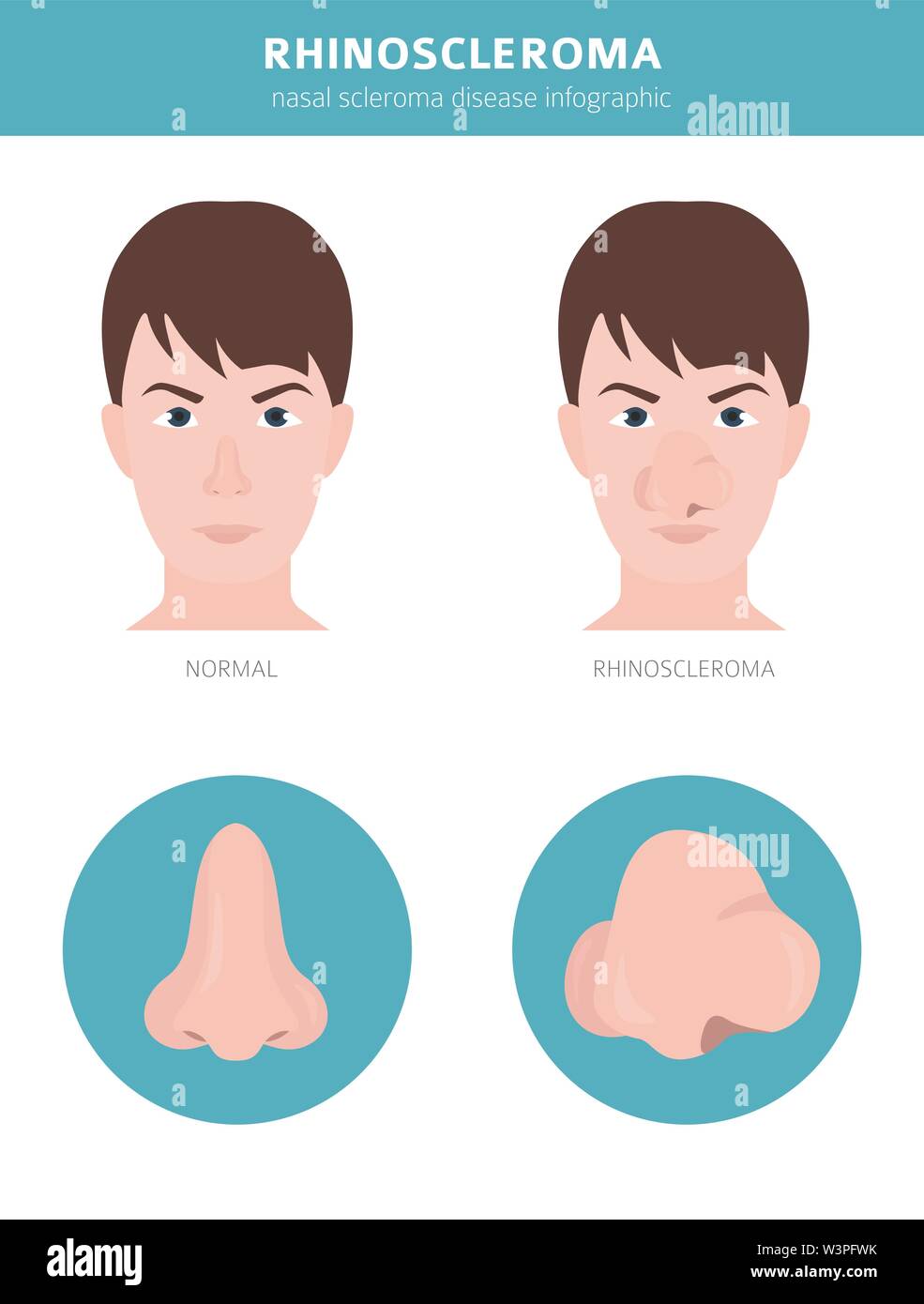 Риносклерома микропрепарат. Лепрозные клетки вирхова. Риносклерома. Риносклерома патанатомия. Риносклерома патологическая анатомия.
