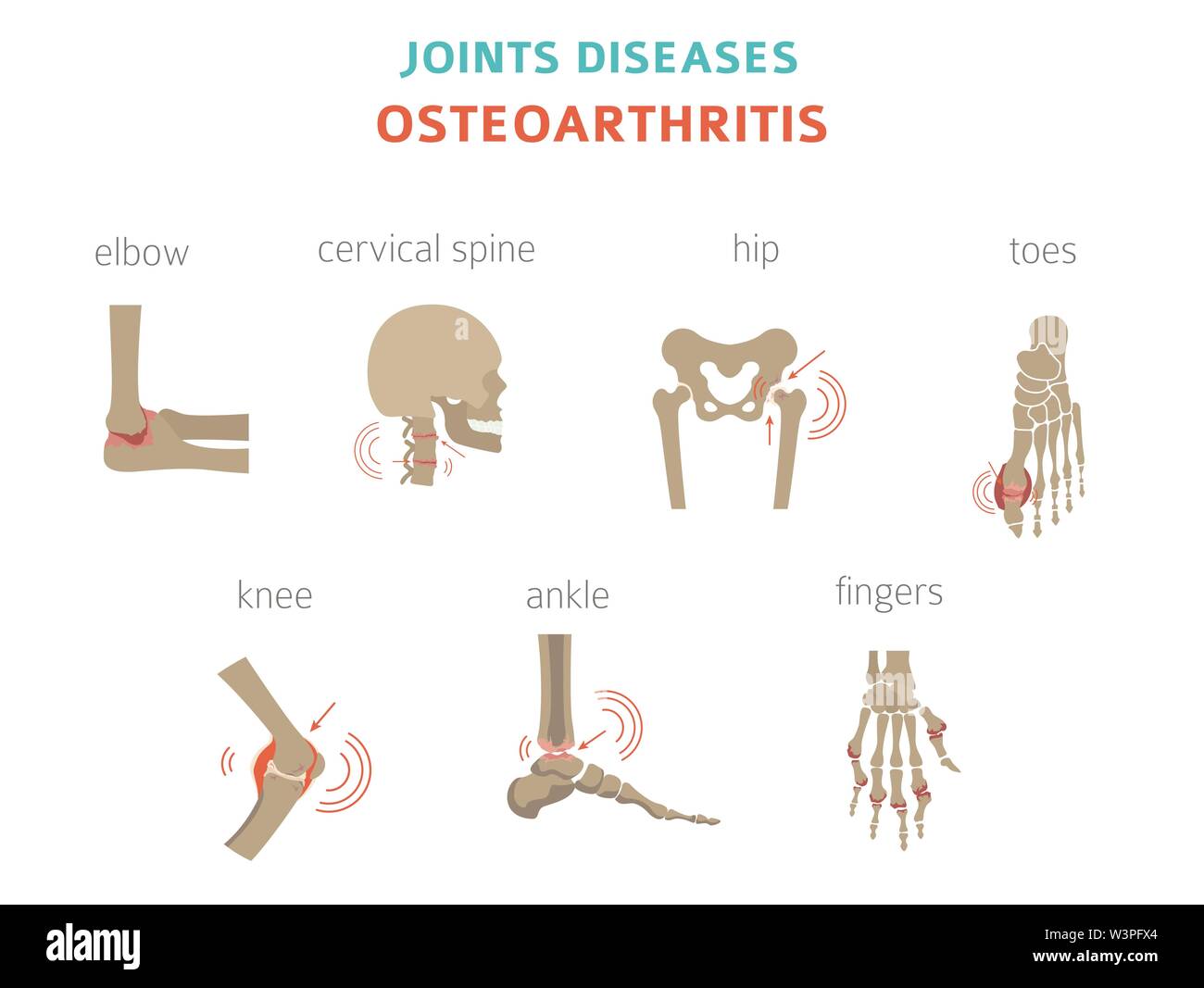 Arthritis, osteoarthritis medical infographic design. Joint replacement
