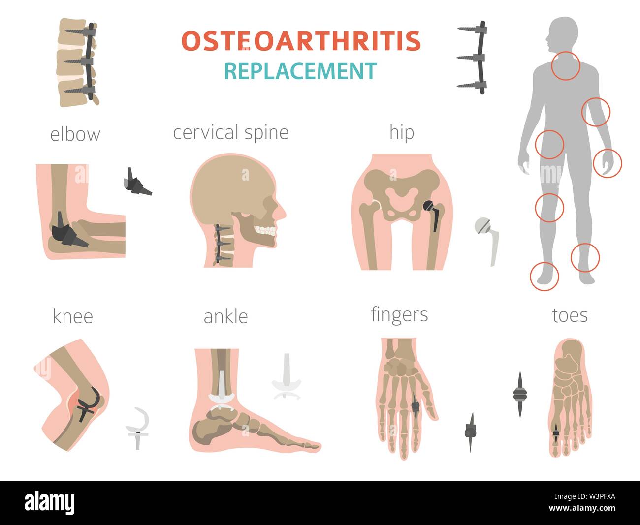 Arthritis, osteoarthritis medical infographic design. Joint replacement, implantant. Vector illustration Stock Vector