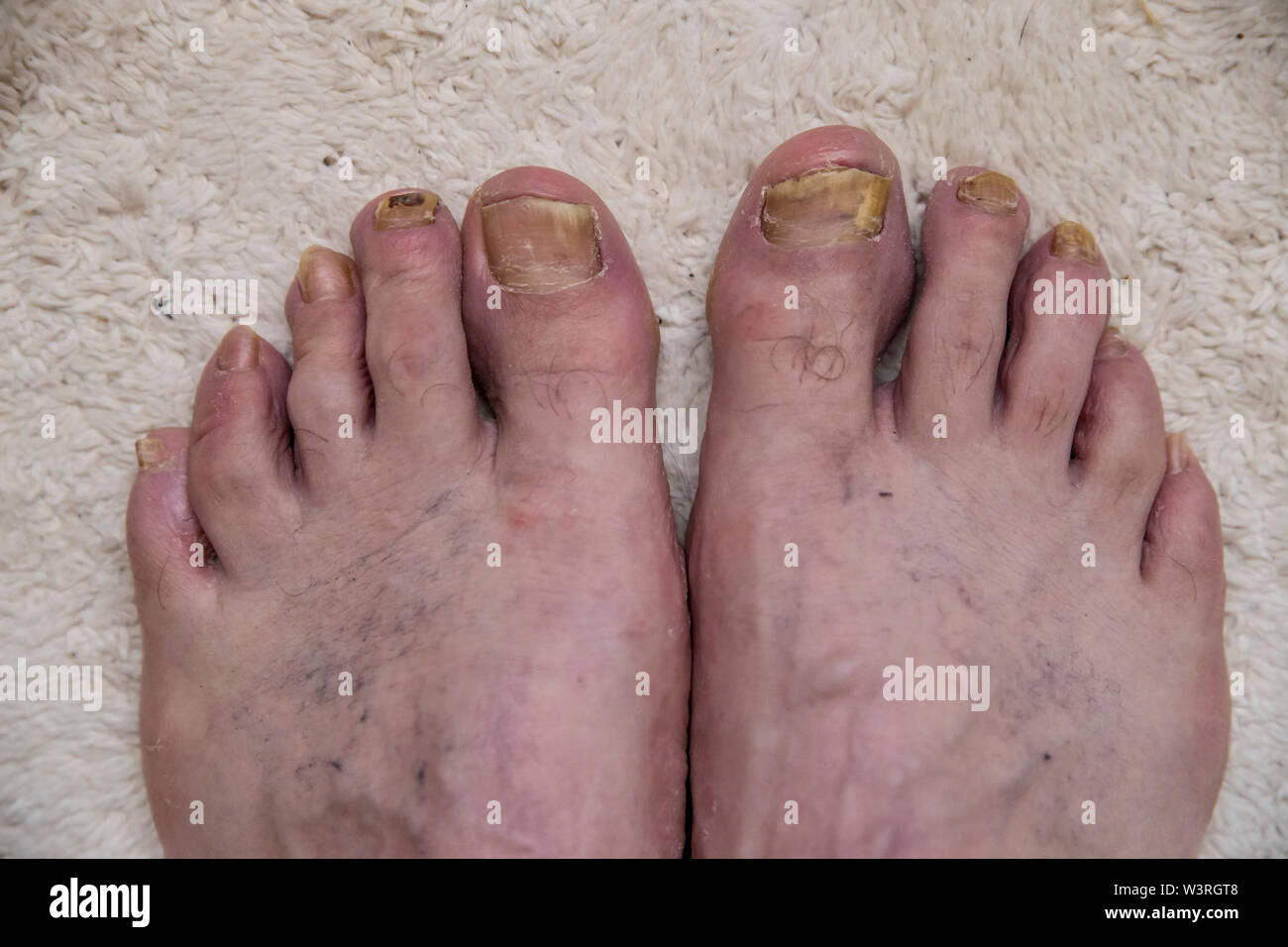 Onychomycosis with fungal nail infection two feet. Stock Photo