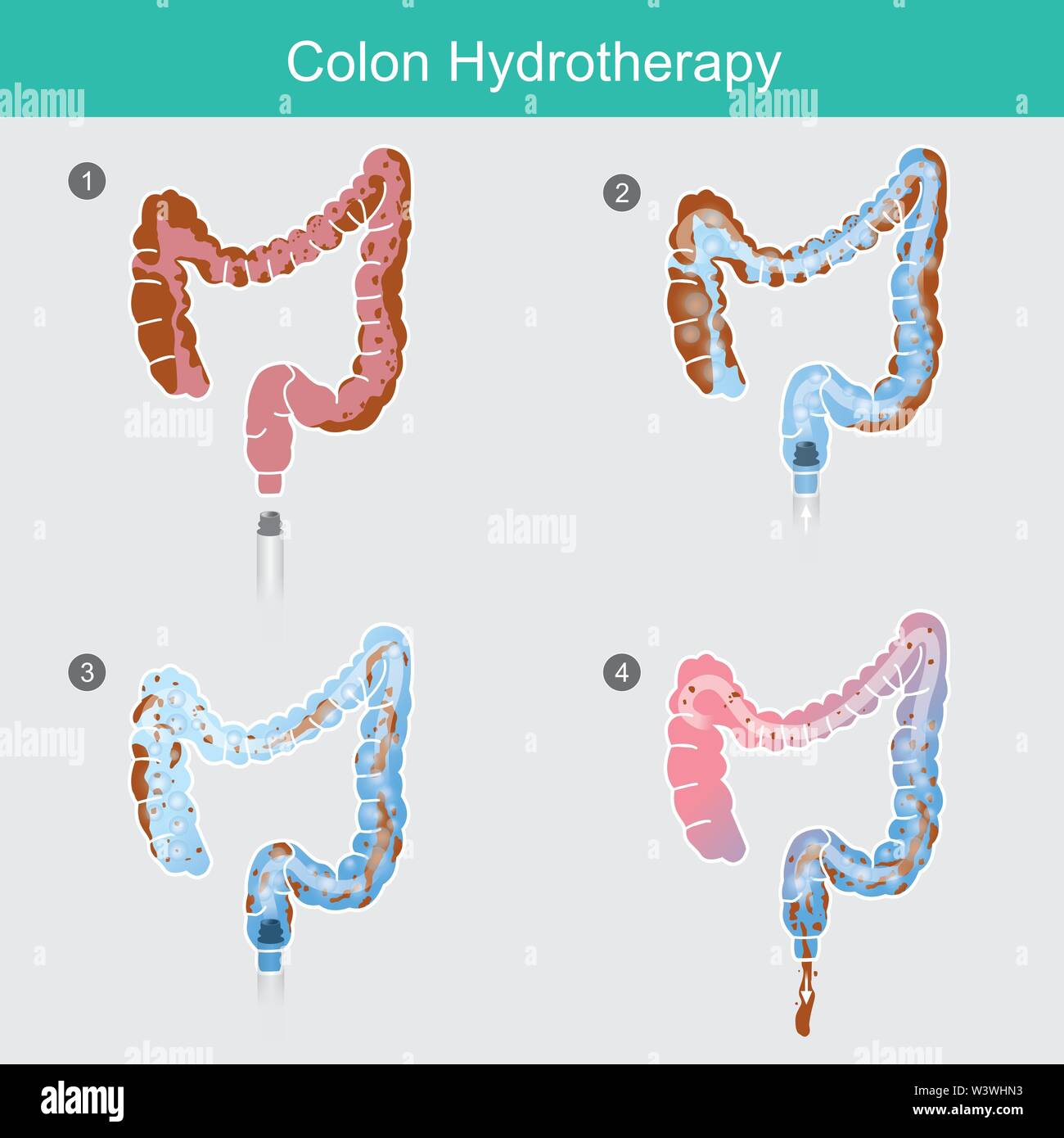 Colon Hydrotherapy. The secreted of waste that accumulates in the colon wall for a long time, Can use the removal method by inserting water solution h Stock Vector