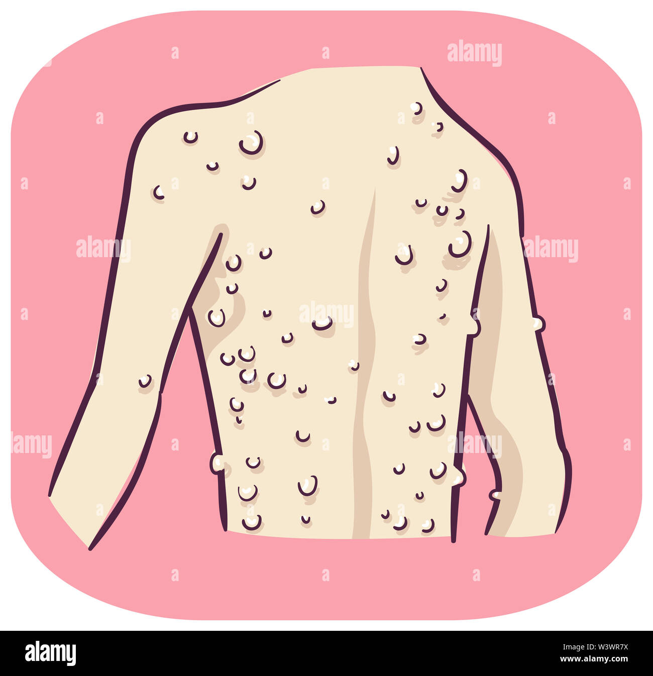 Illustration of Raised Bumps on Skin Mostly at the Back. Neurofibromatosis Stock Photo