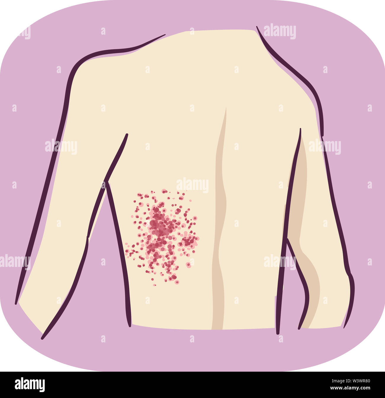 Illustration of Purpura or Purple Discolored Spots on the Back of a Person Stock Photo