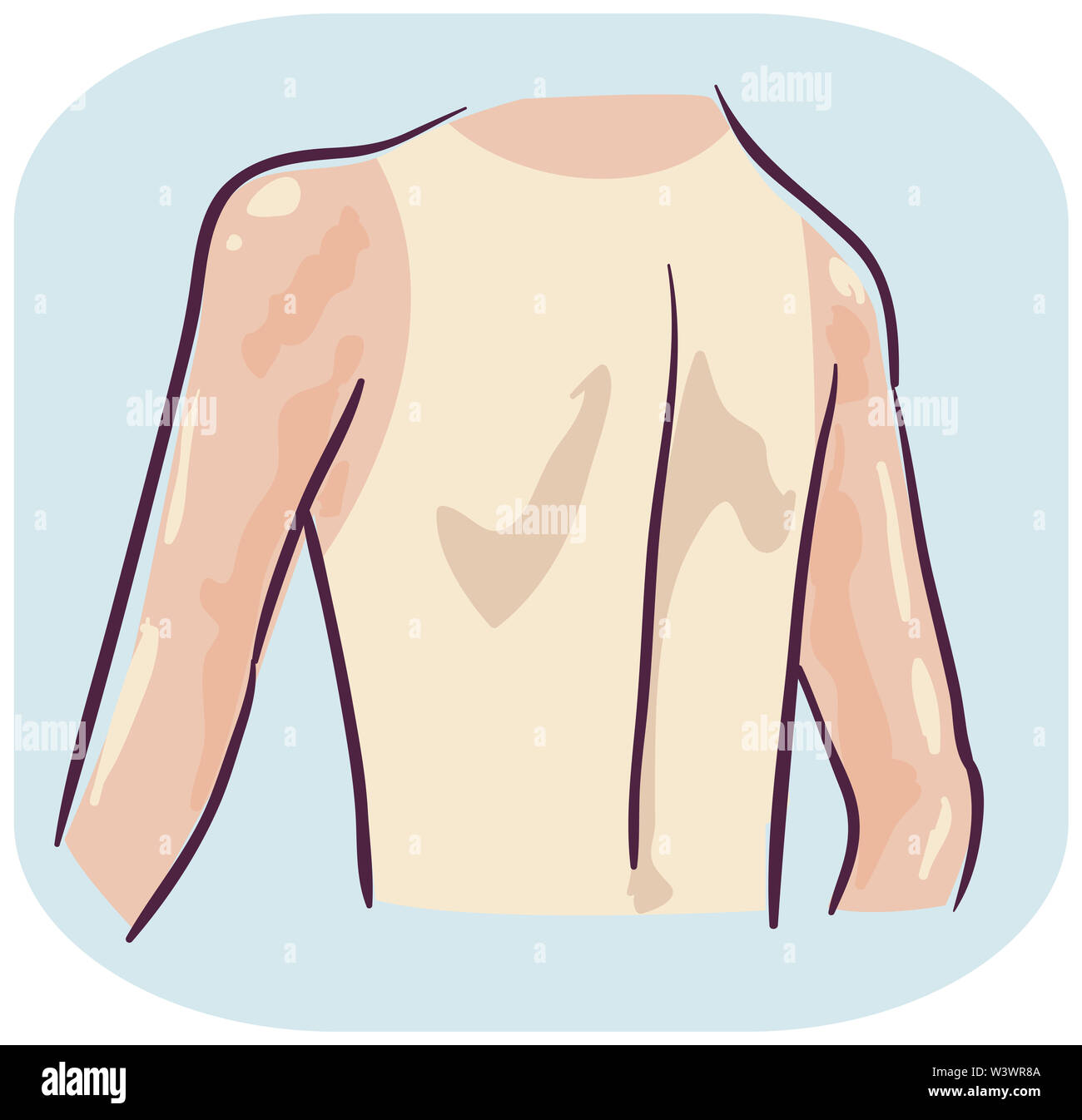 Illustration of a Back of a Man with Sunburn on Arms and Neck Stock Photo