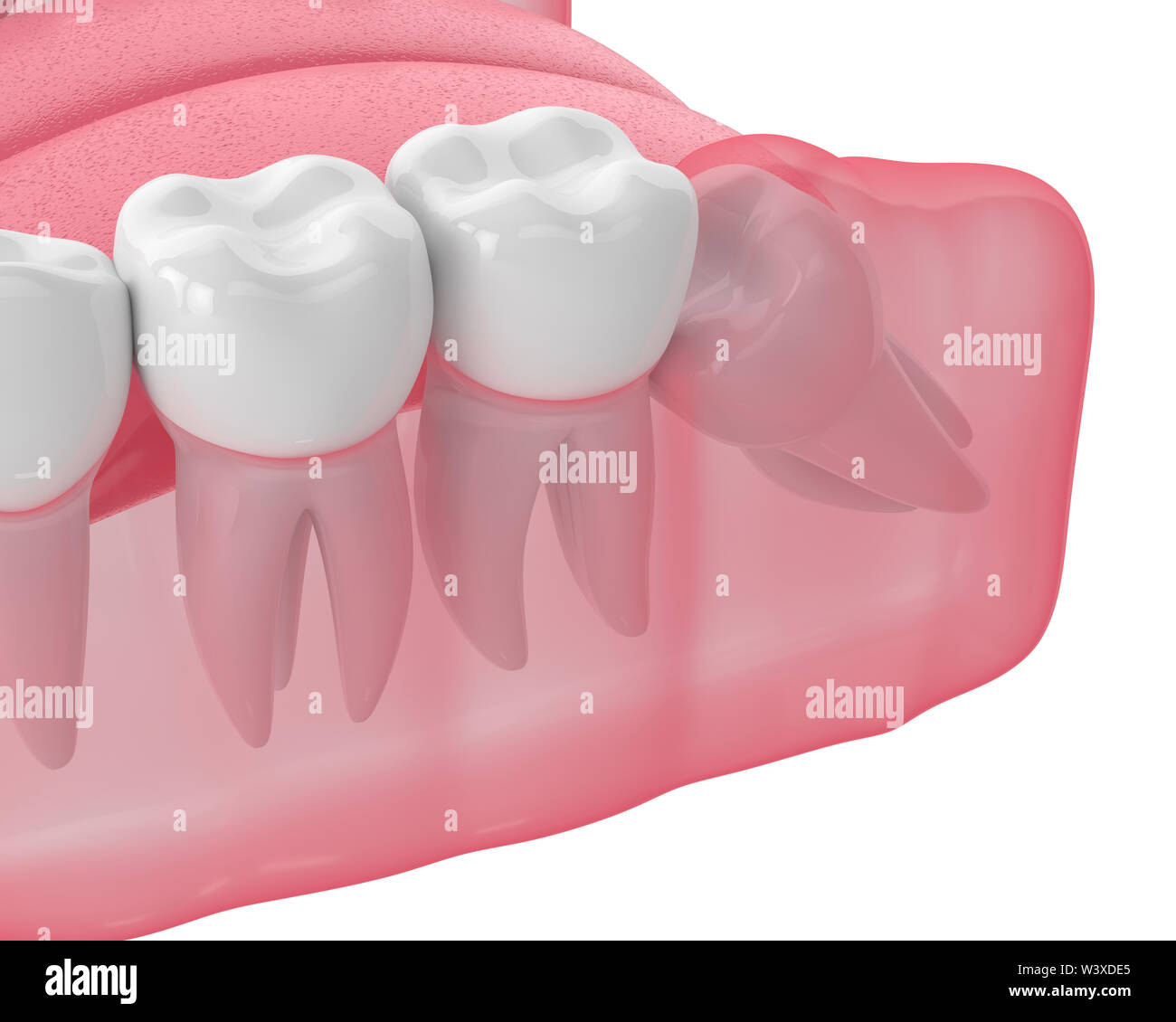 3d render of jaw with wisdom mesial impaction over white background