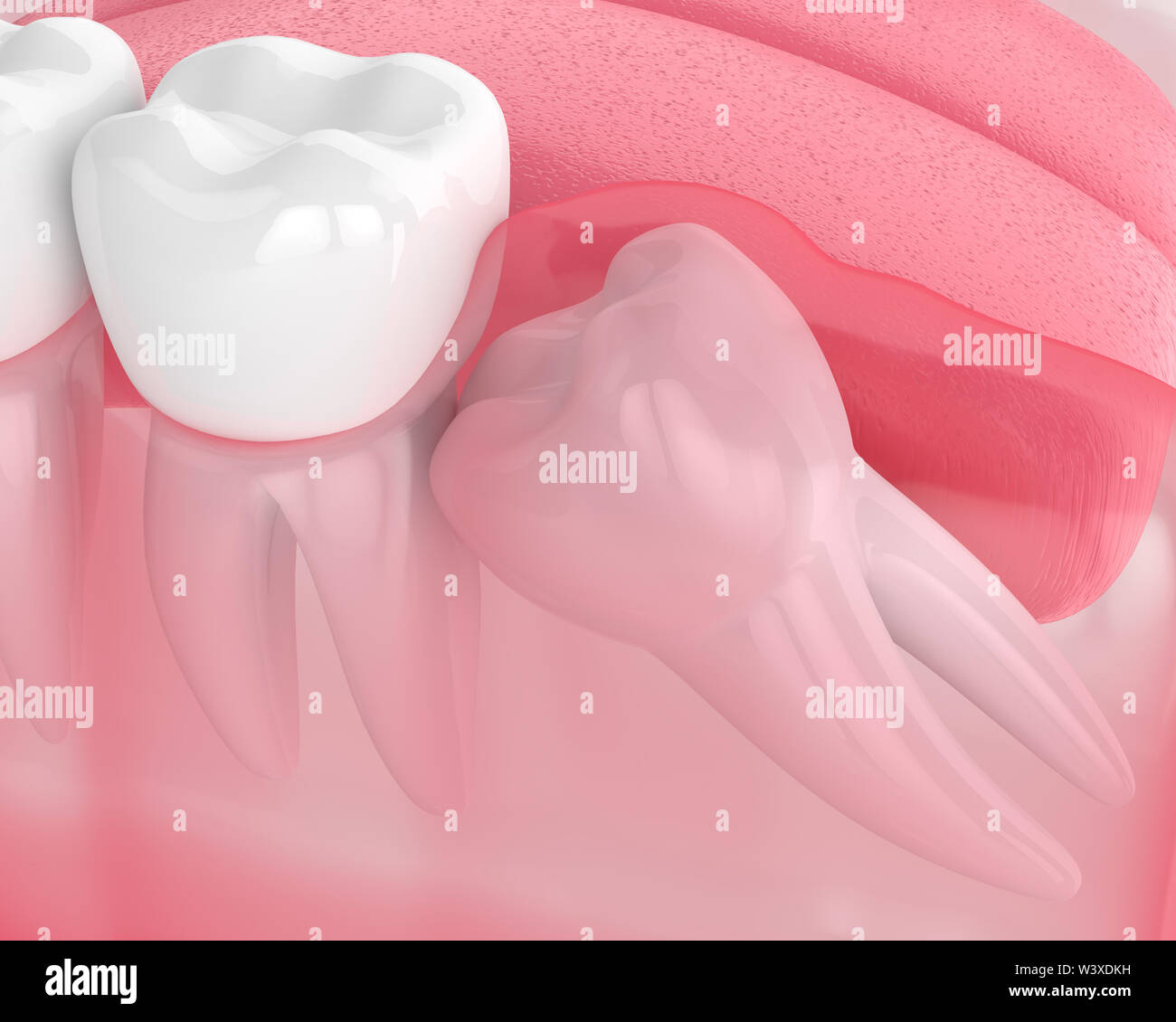 3d render of jaw with wisdom mesial impaction over white background. Concept of different types of wisdom teeth problems. Stock Photo