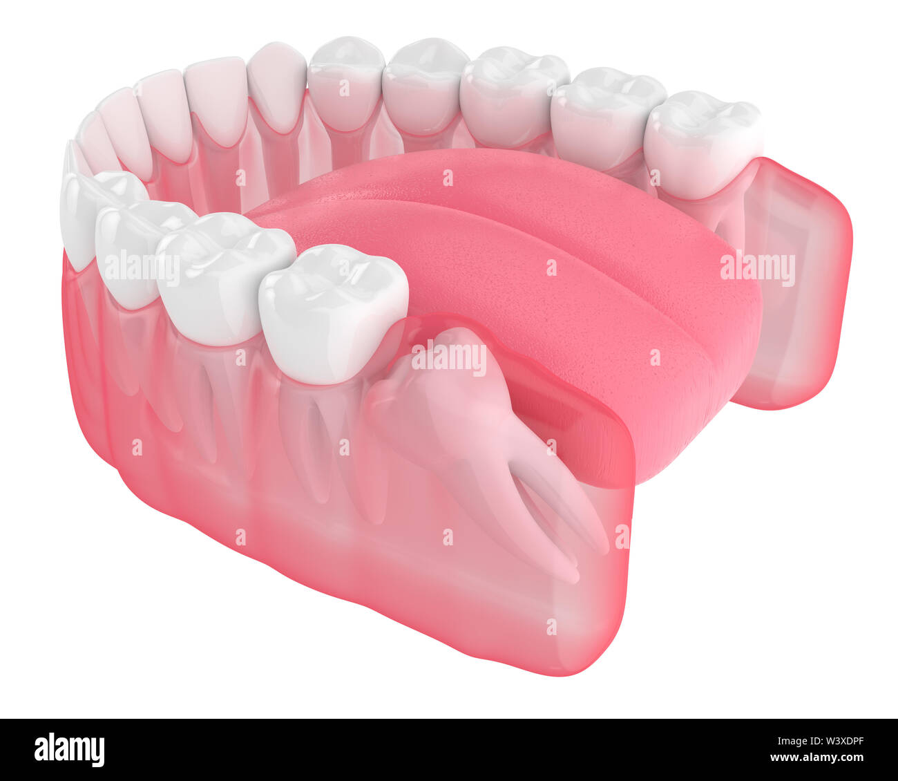 3d render of jaw with wisdom mesial impaction over white background. Concept of different types of wisdom teeth problems. Stock Photo