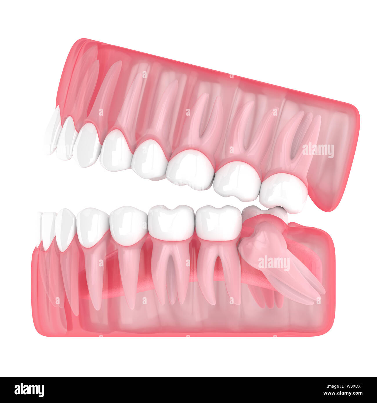 3d render of jaw with wisdom mesial impaction over white background. Concept of different types of wisdom teeth problems. Stock Photo