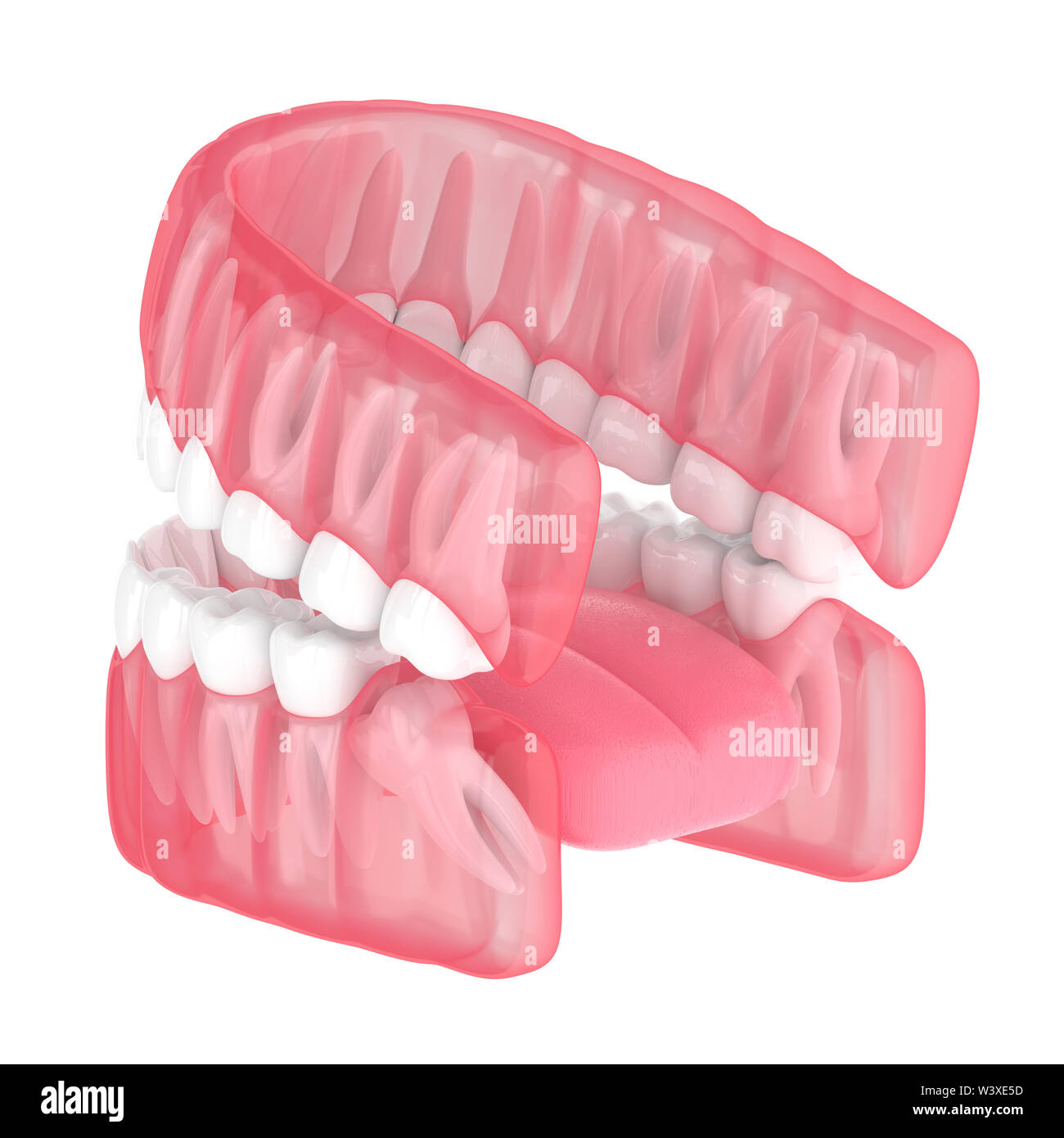 3d render of jaw with wisdom mesial impaction over white background. Concept of different types of wisdom teeth problems. Stock Photo