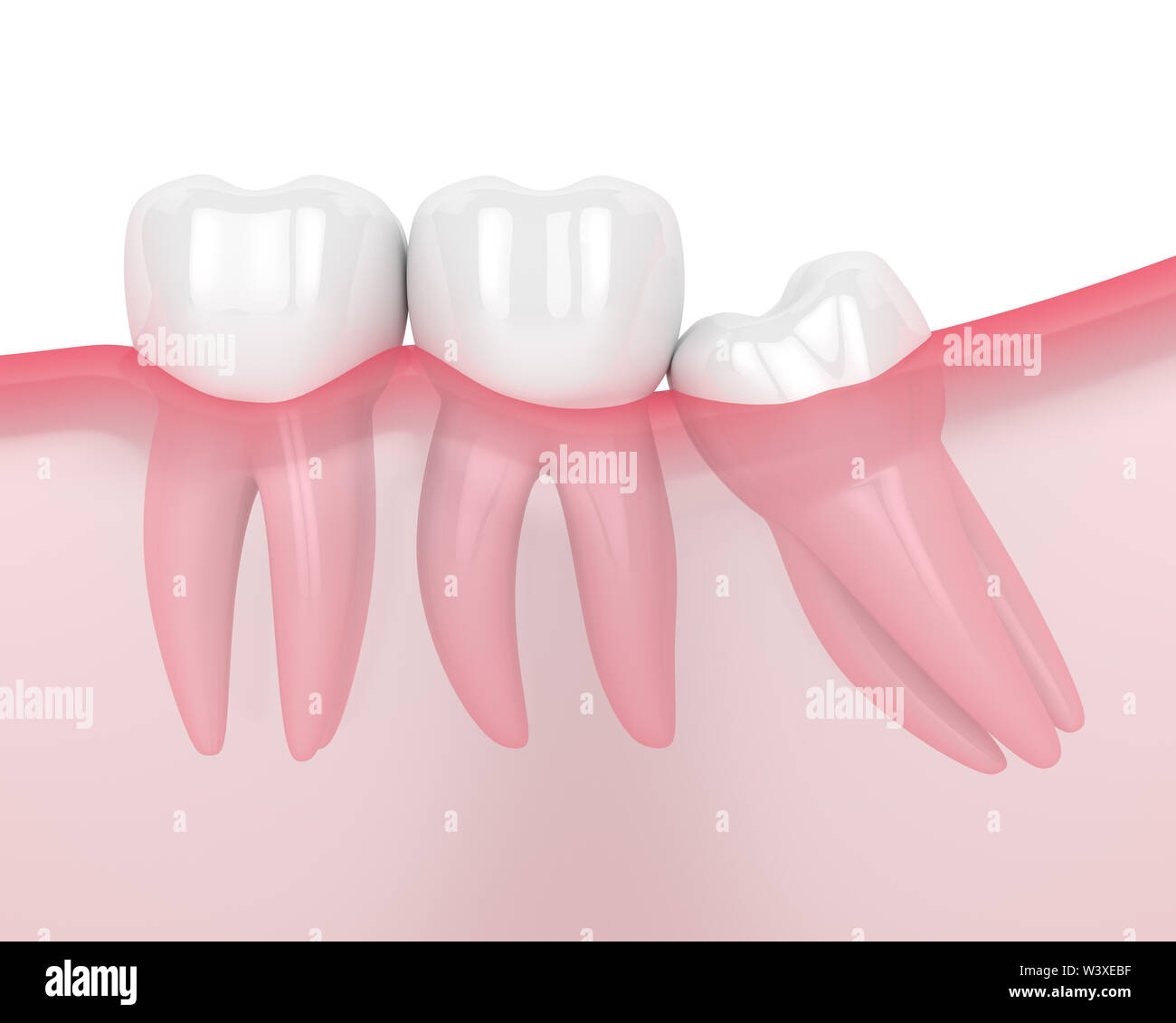 3d render of jaw with wisdom mesial impaction over white background. Concept of different types of wisdom teeth problems. Stock Photo