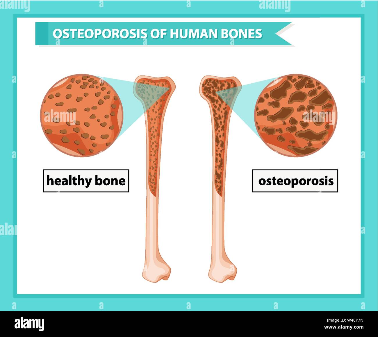 Scientific medical illustration of osteoporosis of bones illustration ...