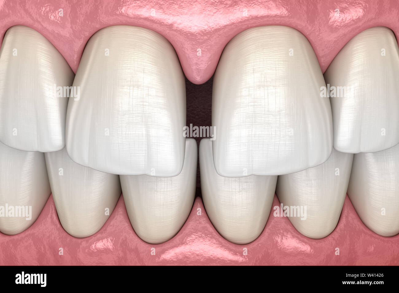 Diastema Of Central Incisors Teeth Dental Disfunction 3d