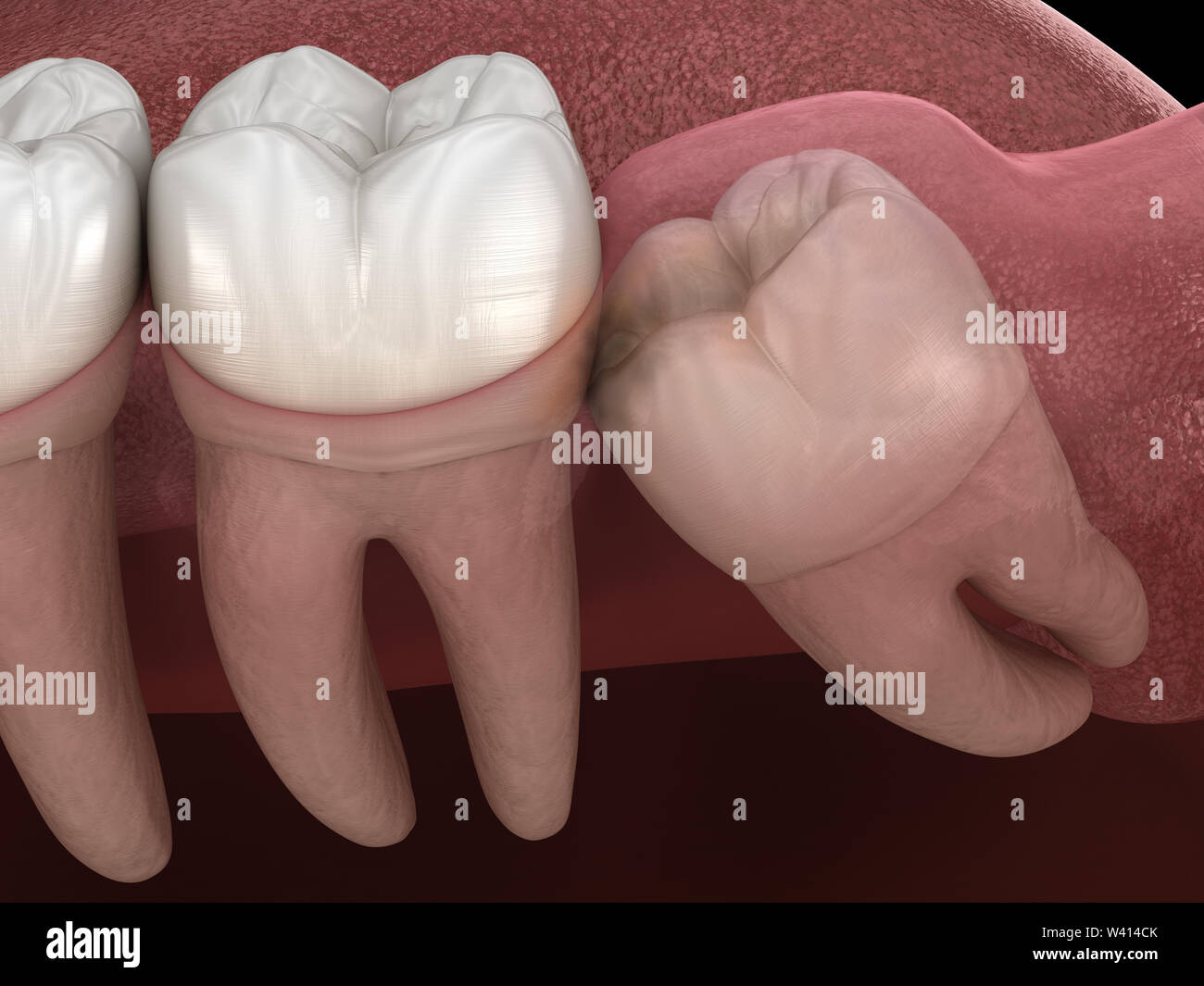 Healthy teeth and wisdom tooth with mesial impaction . Medically accurate tooth 3D illustration Stock Photo