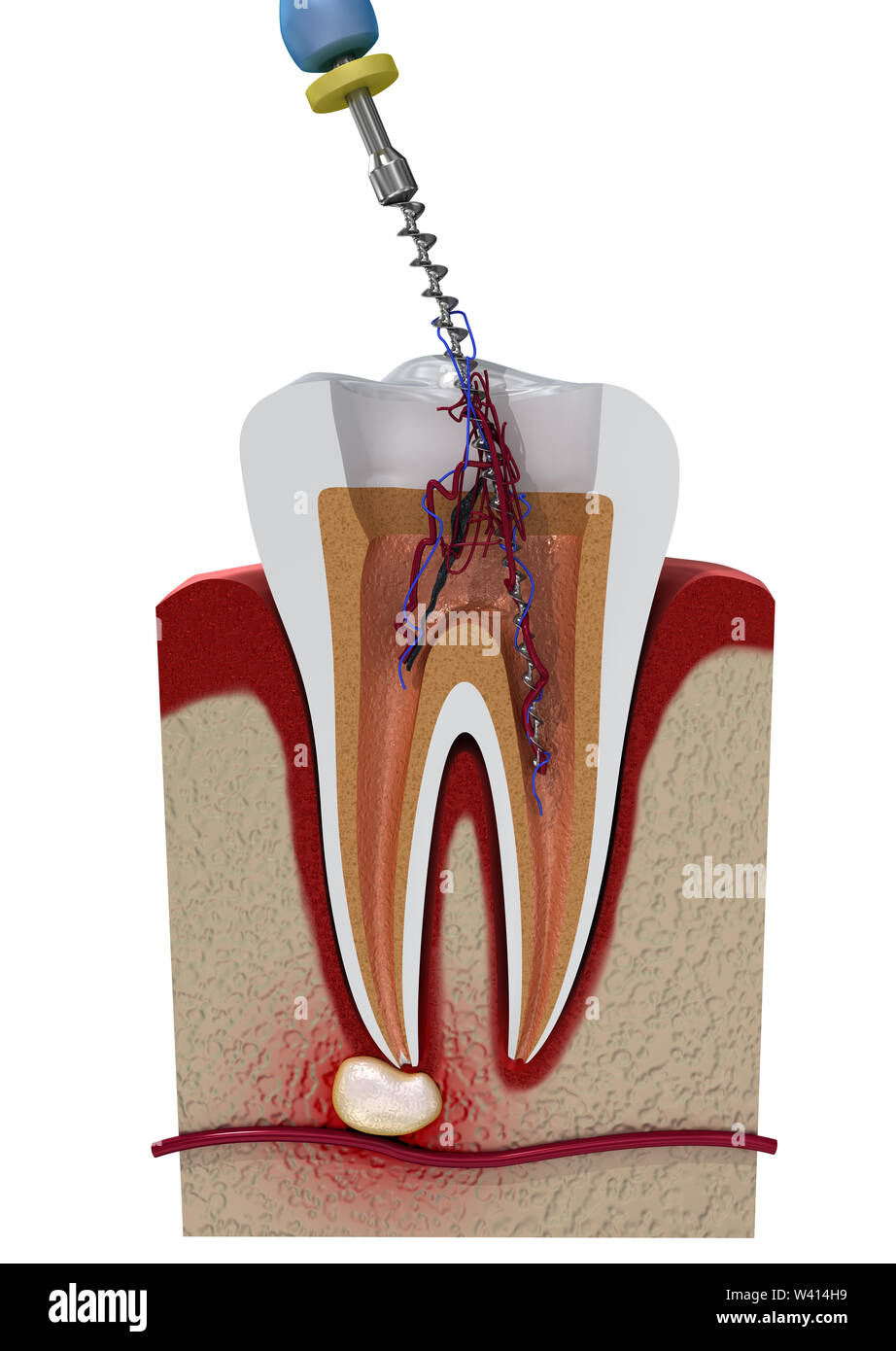 Root canal treatment process. 3D illustration Stock Photo - Alamy