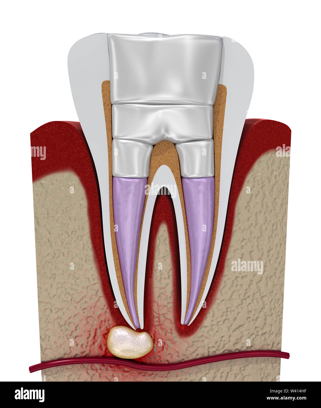 Dental Fillings Procedure Diagramm 3d Illustration Stock Photo Alamy