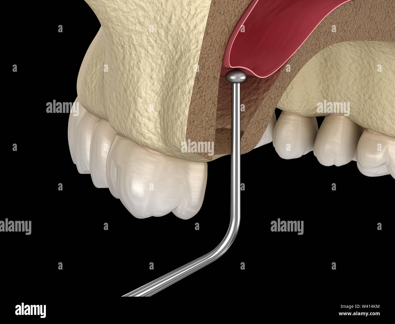 Sinus Lift Surgery - Sinus Augmentation. 3D illustration Stock Photo