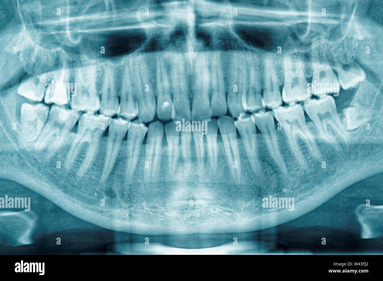 Impacted teeth hi-res stock photography and images - Alamy