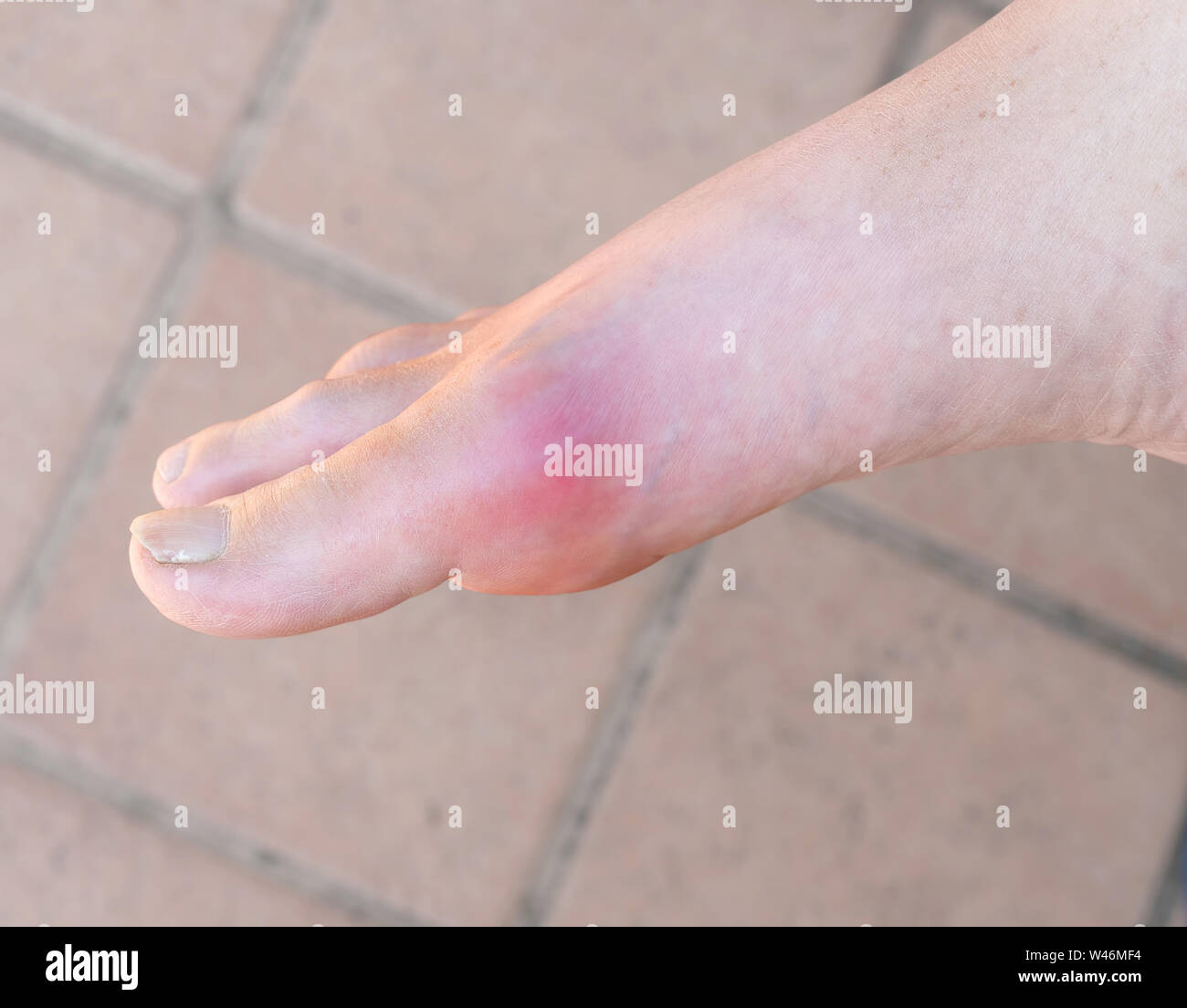Man with painful gout inflammation on big toe joint. Stock Photo