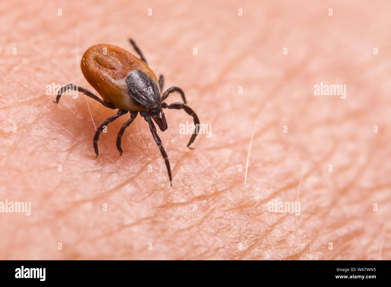 Infected female deer tick on hairy human skin. Ixodes ricinus. Parasitic mite. Acarus. Dangerous biting insect on background of pink epidermis detail. Stock Photo