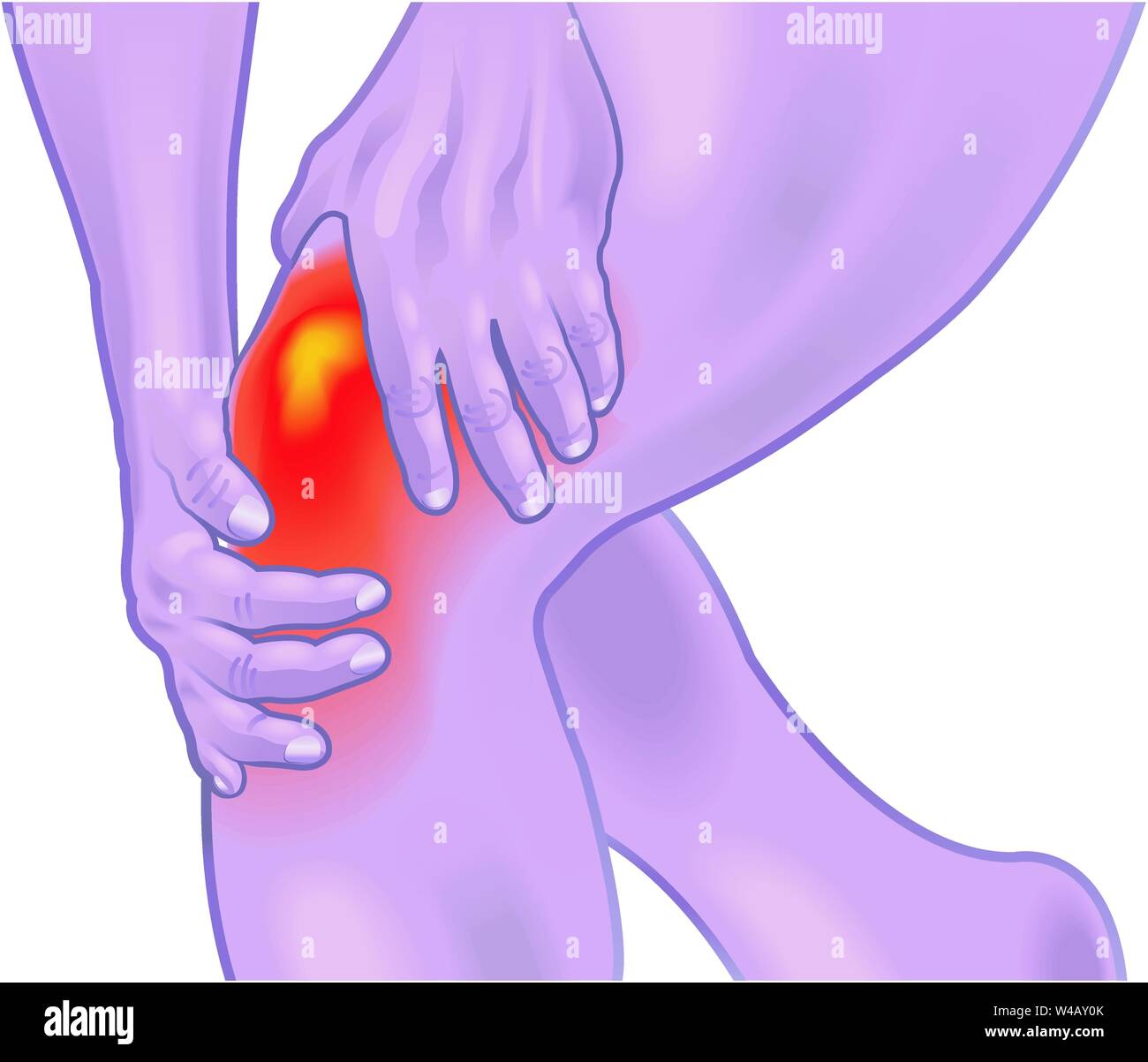 An illustration of a knee with an inflammation of the bursa Stock Vector