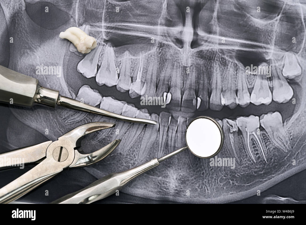 Dental instruments with tooth lying on orthopantomogram Stock Photo Alamy