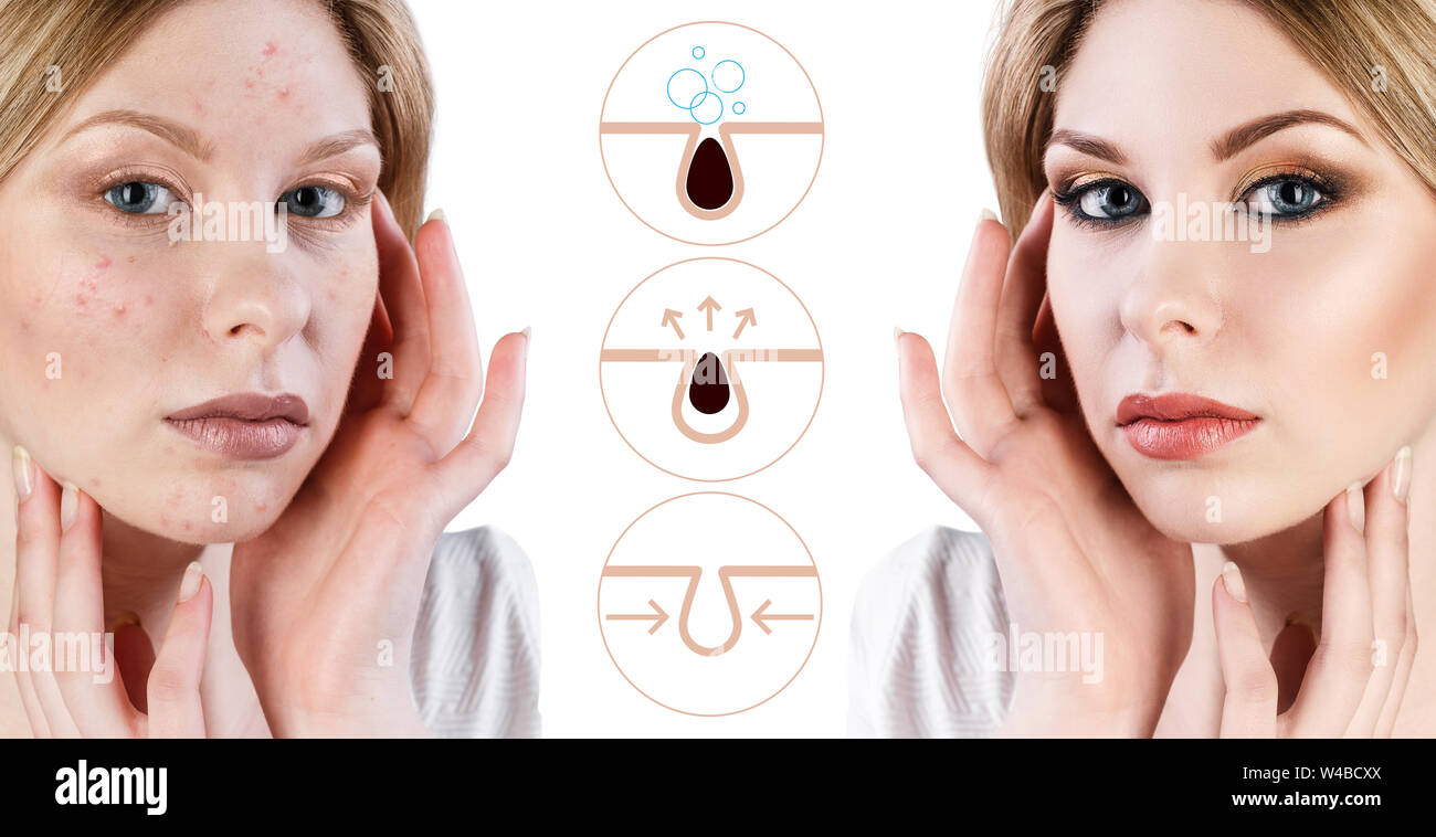 Graphically shows how to pollute and clean the pores on face. Stock Photo