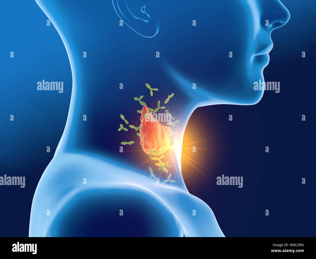 Thyroiditis Hi Res Stock Photography And Images Alamy
